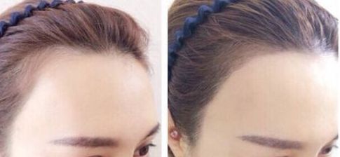 杭州疤痕整形哪家醫(yī)院好？選擇哪個醫(yī)院更靠譜？