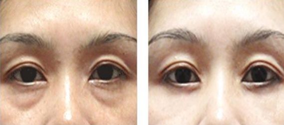 深圳哪家醫(yī)院祛色斑好-四大祛斑療法解密，選擇最適合你的祛斑方式