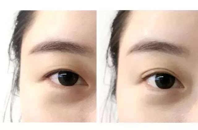 2023成都肉毒素填充術(shù)專家排名top10強(羅承惠、林陽華、劉中國實打?qū)嵉目诒?