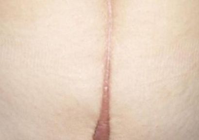 瀘州哪家醫(yī)院祛痘祛痘印好？全面解析瀘州專業(yè)祛痘醫(yī)院