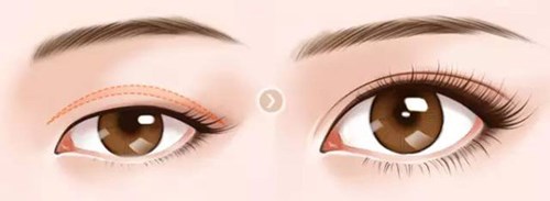 武漢美立方的胡江偉如何進行雙眼皮手術(shù)？