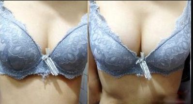 廣州哪家醫(yī)院的乳頭凹陷術(shù)效果好？