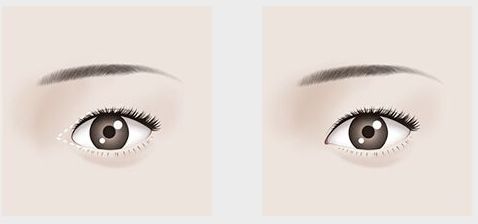 【吉林雙眼皮割的好，哪家醫(yī)院口碑最佳？】