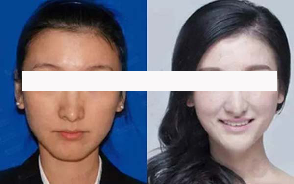 南方醫(yī)院馮傳波修復雙眼皮，專家聲譽和技術(shù)備受認可