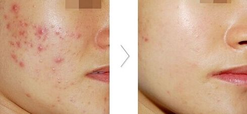 大連雙眼皮整形醫(yī)院哪家好？推薦大連哪家整形雙眼皮效果最佳