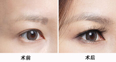 韓國(guó)醫(yī)生張柱允的顴骨磨骨技術(shù)整容潮流。