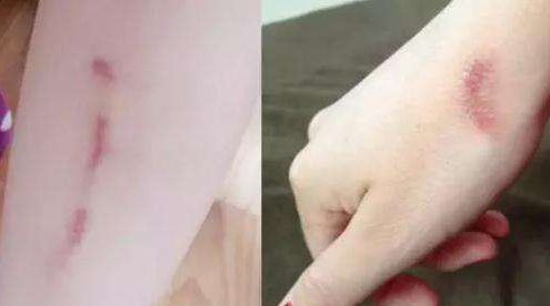 邵陽(yáng)去痘去斑哪家醫(yī)院好？選擇正規(guī)醫(yī)療機(jī)構(gòu)，解決邵陽(yáng)去痘去斑問(wèn)題