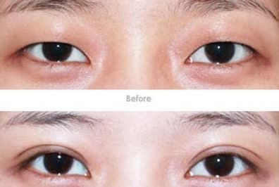 杭州開眼角醫(yī)生哪家好？專家推薦的杭州開眼角醫(yī)院排行榜