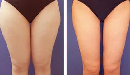 杭州去除雀斑哪家醫(yī)院好？天堂醫(yī)美專業(yè)美容師傾情解答！