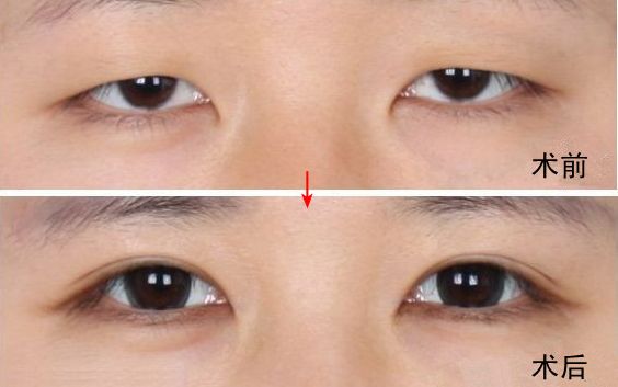 南京哪家醫(yī)院去眼袋好？眼袋手術選哪家醫(yī)院最好