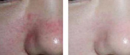 肇慶哪家醫(yī)院激光痣好？最受用戶歡迎的激光痣治療機構有哪些？