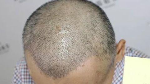 北京哪位醫(yī)生在拉皮手術(shù)方面有口碑？