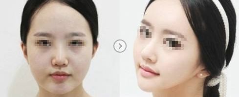 溫州哪家醫(yī)院祛除疤痕效果最佳，專家推薦！