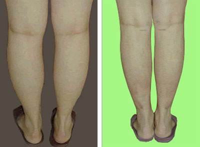 2023深圳熱溶脂減肥醫(yī)生在榜清單top10強(羅雄鵬、易普鋒、張秀麗技術穩(wěn)定，審美在線，不踩坑！)