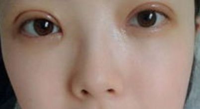 上海哪家醫(yī)院的雙眼皮手術(shù)效果最好？