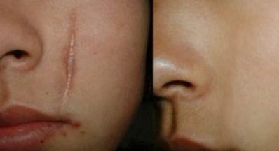 蘭州眼部修復手術(shù)哪家好？眼部整形專家為您推薦最佳選擇！