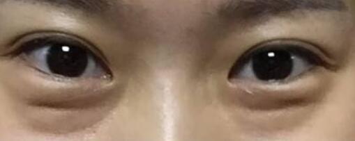 蘇薇潔與楊亞益哪位更適合做雙眼皮？上海美眼大咖實(shí)力測(cè)評(píng)揭曉，你怎么決策？