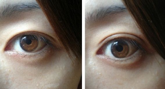 北京開眼角好的醫(yī)院有哪些？