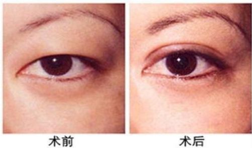 杭州做激光眼科手術哪家醫(yī)院好，專家推薦