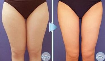 上海光澤醫(yī)院熱瑪吉效果如何？?jī)r(jià)格是多少？搭配醫(yī)生介紹一起了解