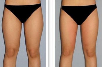 南昌哪家全科醫(yī)院有最好的外切眼袋手術(shù)效果？