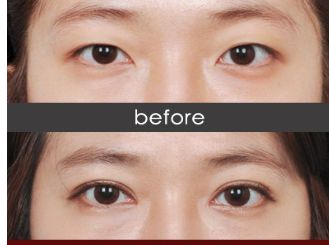 衡陽哪家醫(yī)院瘦臉針效果好且價(jià)格合理？