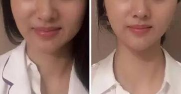 杭州激光祛斑好嗎？哪家激光祛斑的效果好？