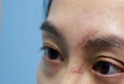 成都哪家醫(yī)院的脂肪填充臉效果好且安全？