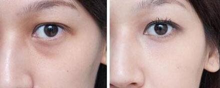 成都八大處：李發(fā)成精準(zhǔn)面部脂肪注射實(shí)例分享