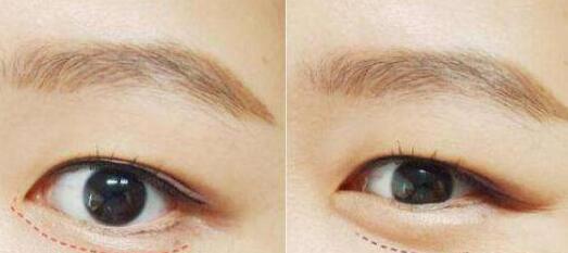 增美天使沈正宇教你打造完美鼻梁！深度揭秘示范案例，秀出新顏！