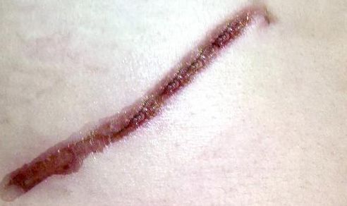 鐳射溶脂杭州哪家醫(yī)院好？專(zhuān)家推薦排名前三的權(quán)威醫(yī)院