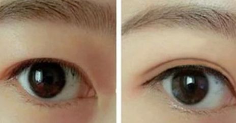 杭州同榮麗格郭同榮抽脂效果如何？醫(yī)生評(píng)價(jià)怎樣？