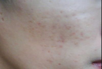 寧波祛疤哪家醫(yī)院哪里好？專家告訴你最佳選擇！