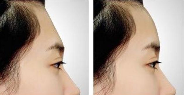 南京割雙眼皮哪家醫(yī)院效果好？