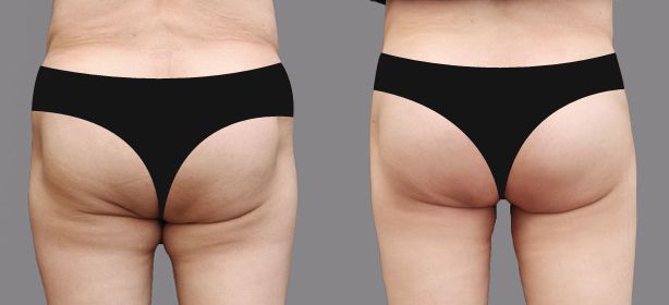 上海吸脂豐胸醫(yī)院哪家好？選擇最值得信賴的上海豐胸整形醫(yī)院