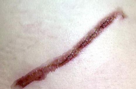 成都去法令紋哪家醫(yī)院好？找到適合你的放心醫(yī)院