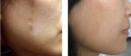 廣州抽脂手術(shù)哪家醫(yī)院最靠譜？