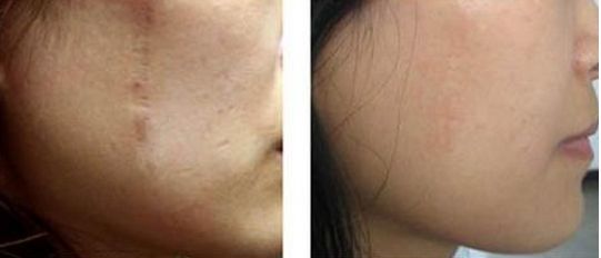 長春激光祛痘，哪家好？排名靠前的專業(yè)美容機(jī)構(gòu)有哪些？