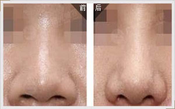 2023鄭州假體隆鼻術口碑排行前10醫(yī)生(汪金國、尹彩霞、林敬華深得人心！)