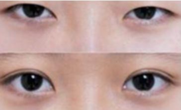 秦皇島雙眼皮哪家做的好？選擇前必看！