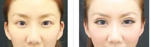 株洲哪家醫(yī)院做雙眼皮好？選擇醫(yī)院要注意這幾個(gè)關(guān)鍵點(diǎn)！