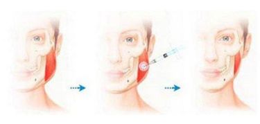 南京假體隆鼻哪家醫(yī)院效果最好？