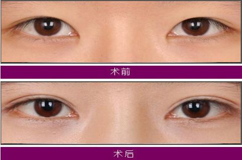 大連注射玻尿酸哪家醫(yī)院技術(shù)好，效果持久？