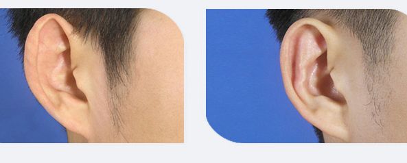 上饒哪家韓式雙眼皮醫(yī)院專業(yè)且值得信賴的推薦？