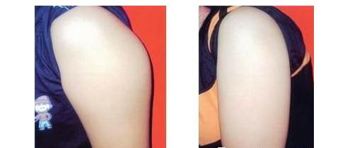 福州格萊美植發(fā)治療良效如何？黃興勇醫(yī)生發(fā)際線安全種植真的有效嗎？