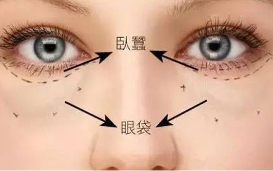 ?？谀募裔t(yī)院做眼袋效果好？