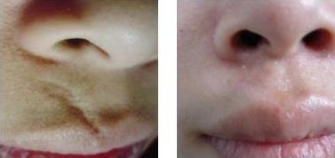 常州墊鼻梁哪家醫(yī)院好？專家推薦常州最受歡迎的鼻梁整形醫(yī)院