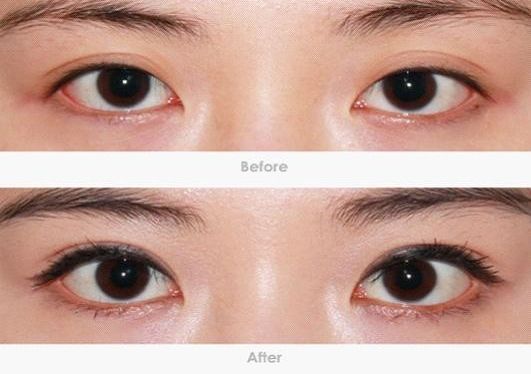 深圳哪家專業(yè)去黑眼圈機構靠譜？