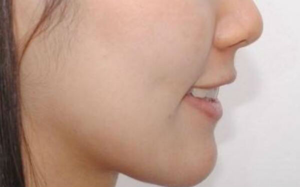 成都藝星周順波與陳遠(yuǎn)坤鼻子整形實力對決！術(shù)前比較，看誰更擅長鼻子！