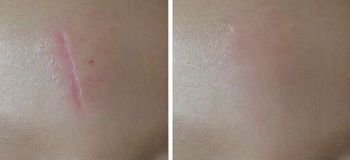 鄭州哪家醫(yī)院激光做的好？找尋專業(yè)！領(lǐng)先的鄭州醫(yī)院激光治療推薦